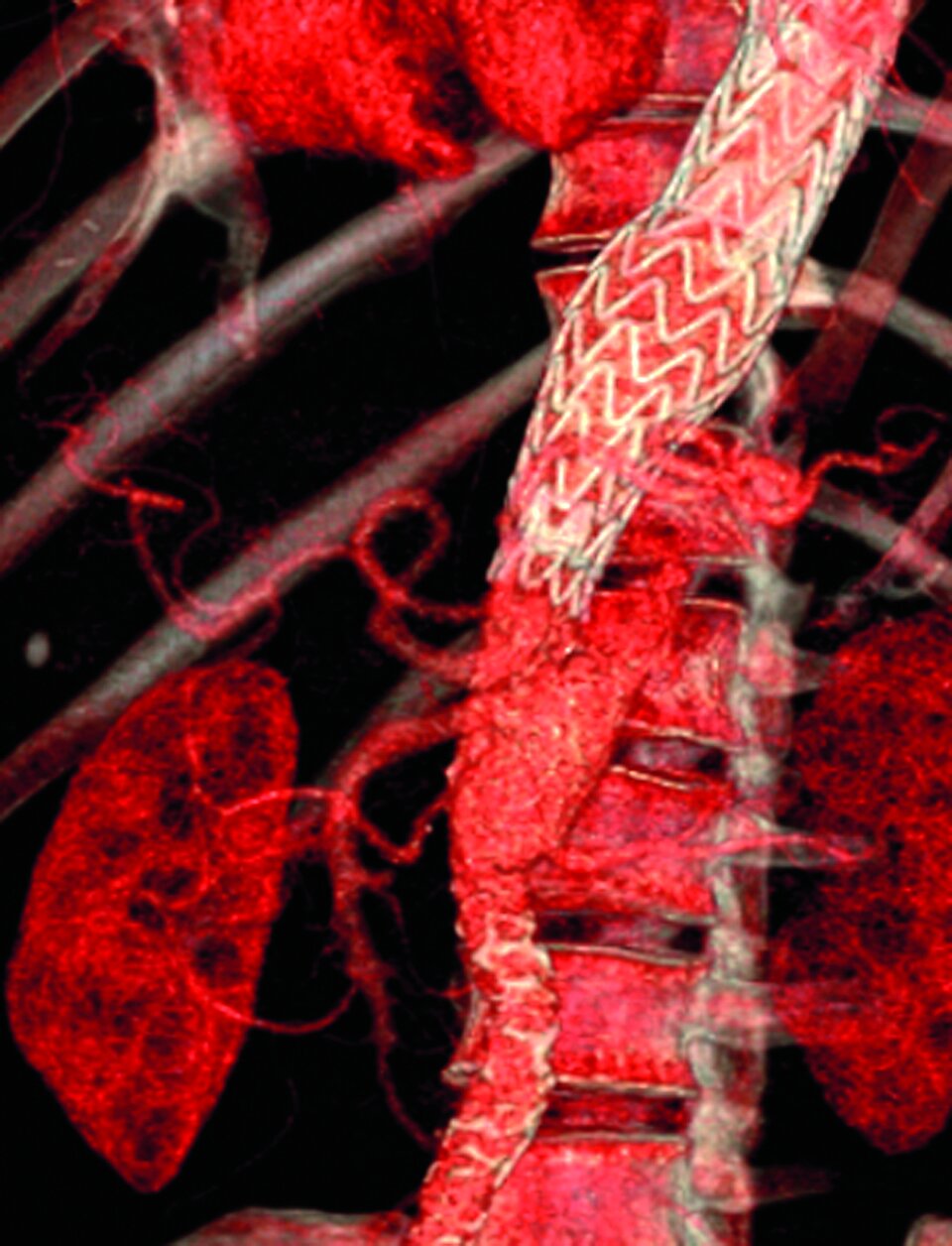 Für die Therapie der thorakalen Aorten­dissektion kommt auch die Implantation eines endovaskulären Stents in Betracht. 
