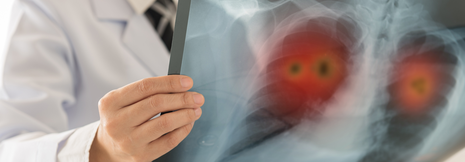 NSCLC: Checkpoint-Inhibition plus Chemotherapie wirksam bei PD-L1-Expression von 1–49 %