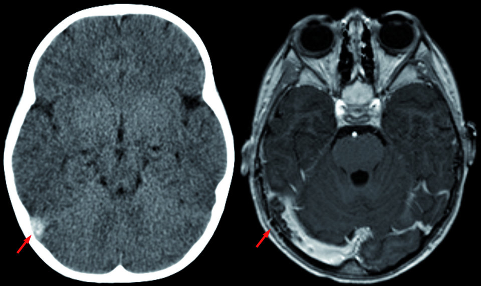 Im CT ohne Kontrastmittel (links) und im MRT mit Kontrastmittel (rechts) lässt sich eine Sinusvenenthrombose gut erkennen.