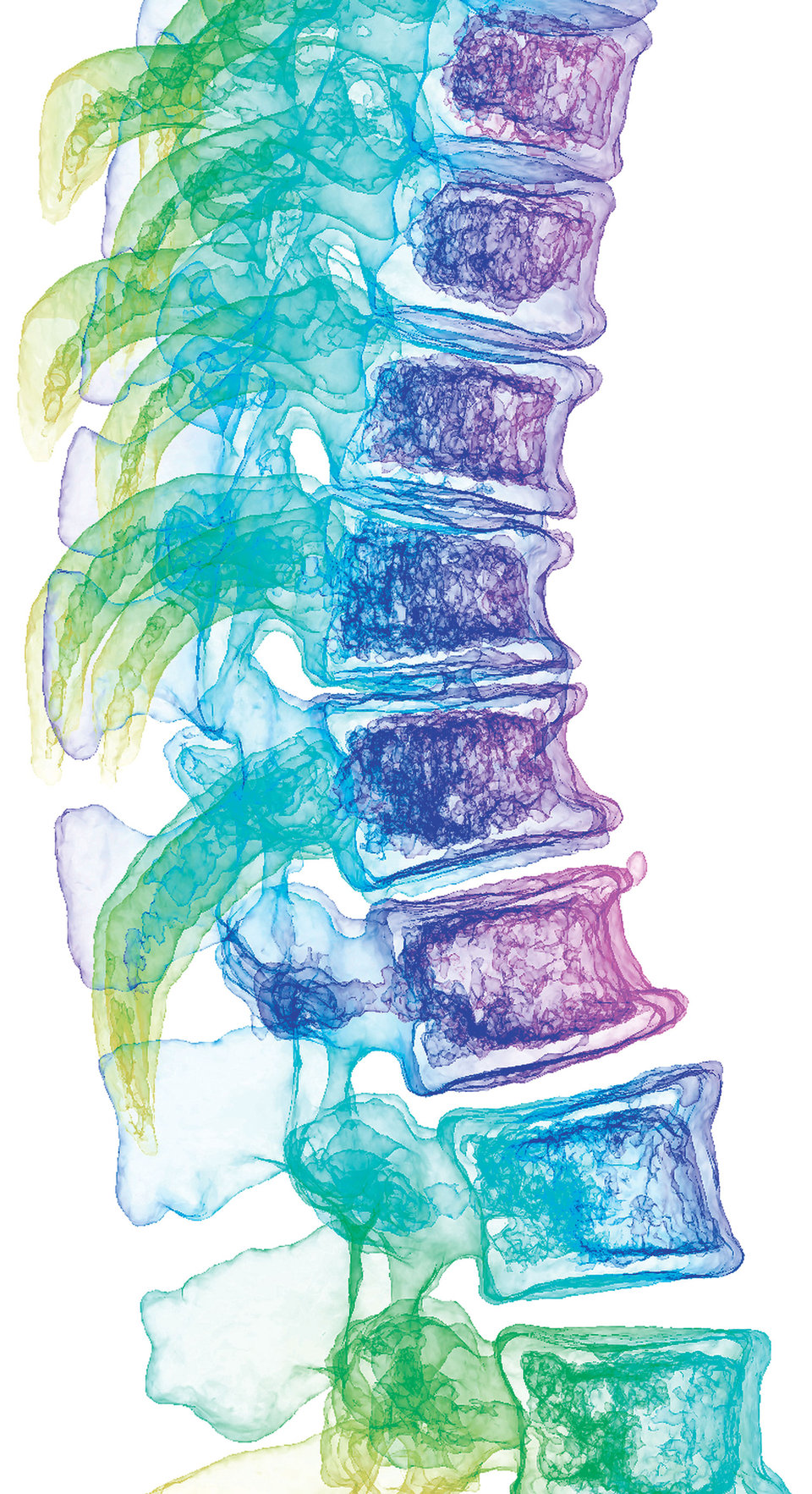 Osteoporose mit Kyphose sowie eingebrochenen und höhenverminderten Wirbelkörpern (kolorierter 3D-Scan).