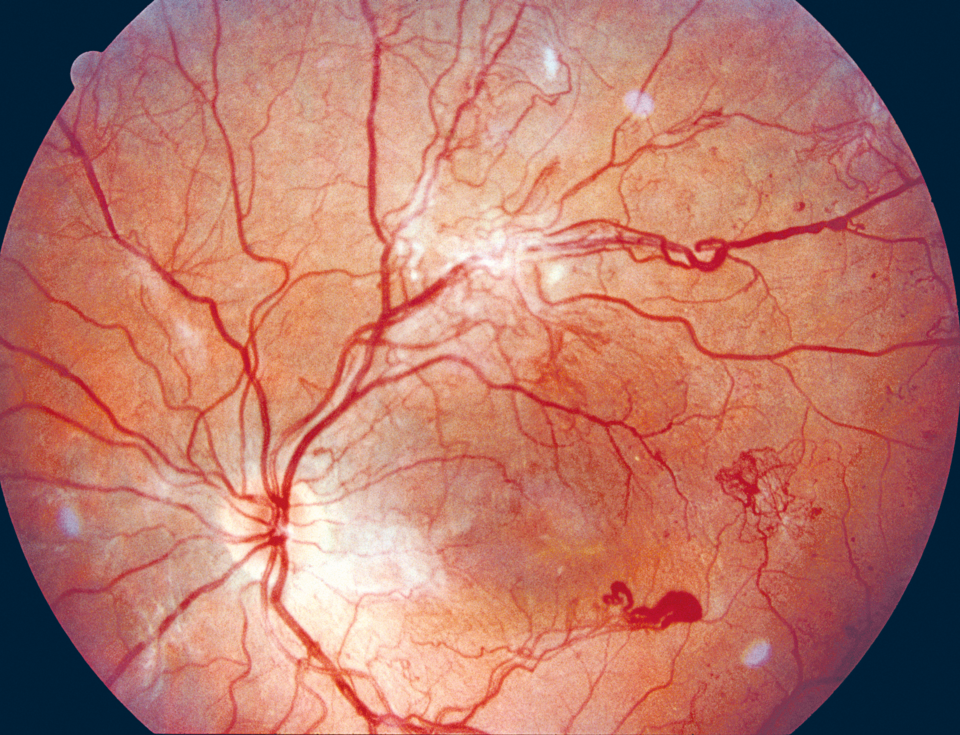 proliferative Retinopathie