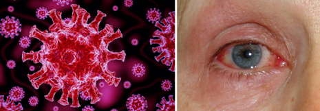 Augen auf bei COVID-19: Bindehautentzündung durch Corona-Infektion