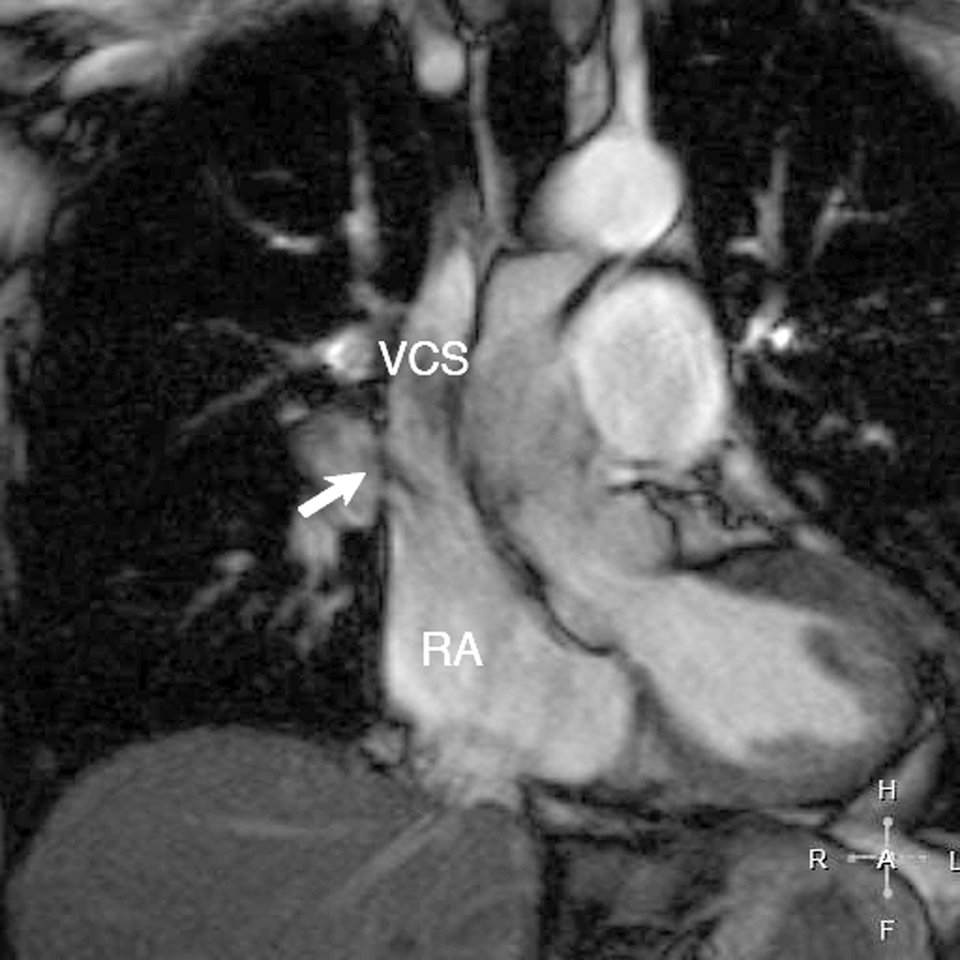 Das MRT brachte die Fehleinmündung der oberen rechten Pulmonalvene in die Vena cava superior ans Licht 