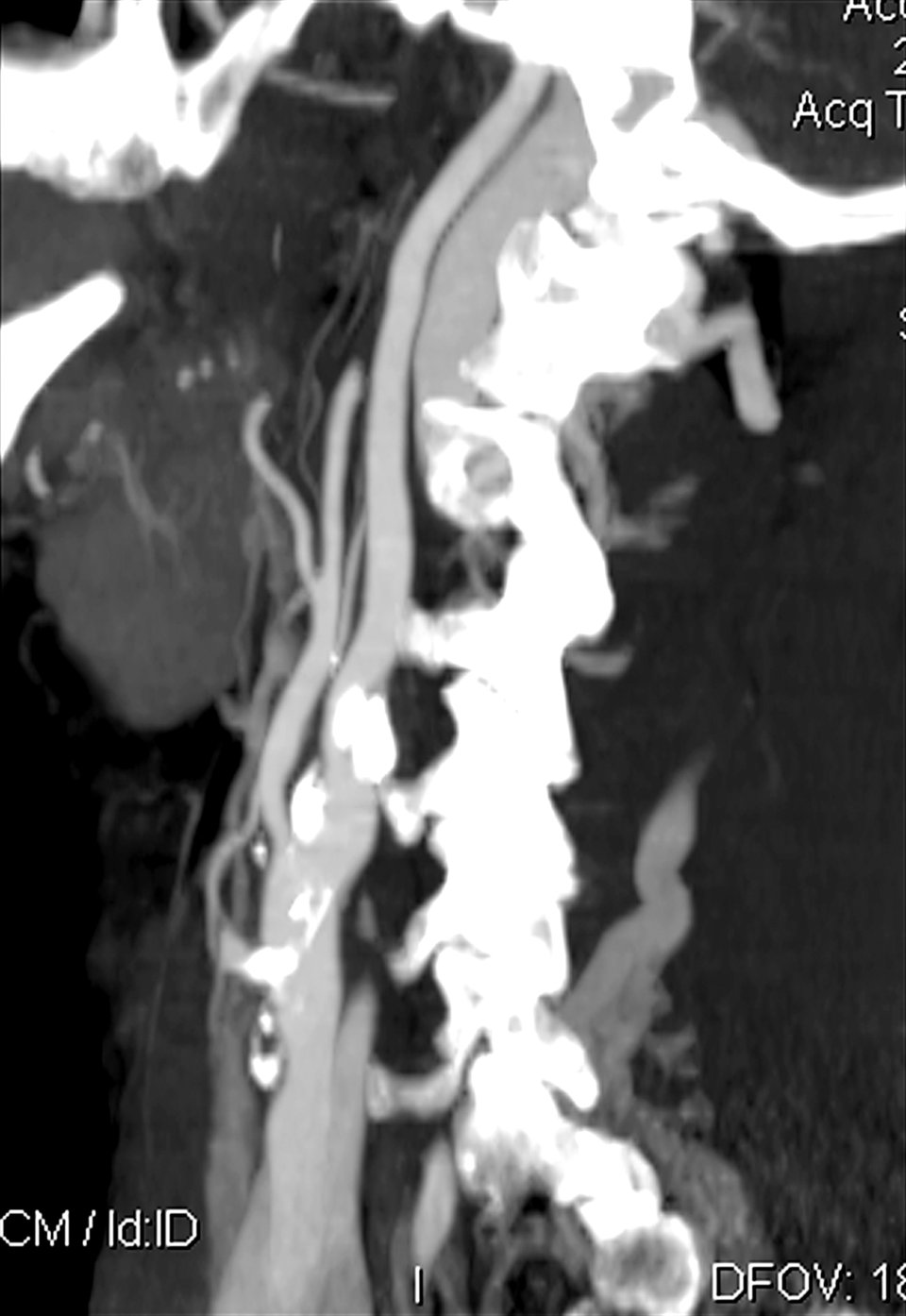 Im CT-Angiogramm sind im Bereich der Karotis arteriosklerotische Plaques (weiß) zu erkennen.