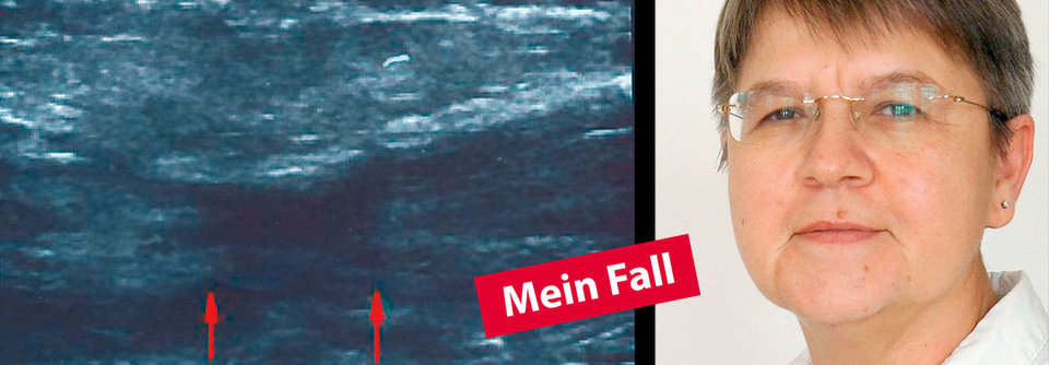 Bein gelähmt nach durchzechter Nacht Kasuistik von Dr. Edith Leisten, Fachärztin für Chirurgie MVZ St. Marien GmbH Köln.
