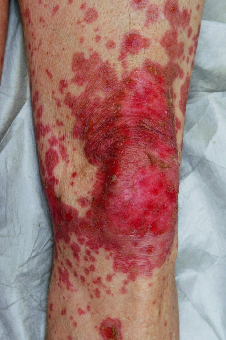 Abb. 3: Klinisches Bild eines bullösen lichenoiden Arzneimittelexanthems am Bein. Erst zeigen sich erythematöse, livide Maculae und Papeln. Später konfluieren die Maculae und es kommt zu Plaques mit Epidermolyse und sekundären Erosionen. Hinzukommen kann ein leicht bis moderat reduzierter Allgemeinzustand.