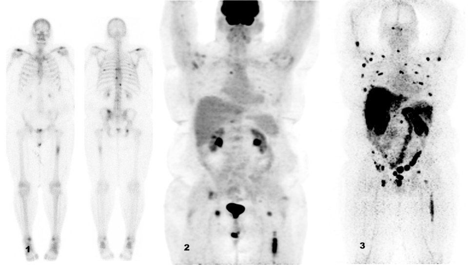 Vergleich der Läsionsdarstellung bei Patienten mit metastasierendem Prostatakarzinom:
(1) Die Knochenszintigraphie mit Technetium-99m-Methylendiphosphonat (Tc-99m-MDP)
zeigt Läsionen in Wirbeln und Rippen.
(2) Der PET-Scan bildet Läsionen im linken Femur und eine Metastase im Wirbel ab.
(3) Das PET/CT mit dem neuen 89Zr-markierten Anti-PSMA-Tracer (Zr-89-IAB2M) macht, im Vergleich zu den beiden anderen Scans, deutlich mehr Läsionen sichtbar.