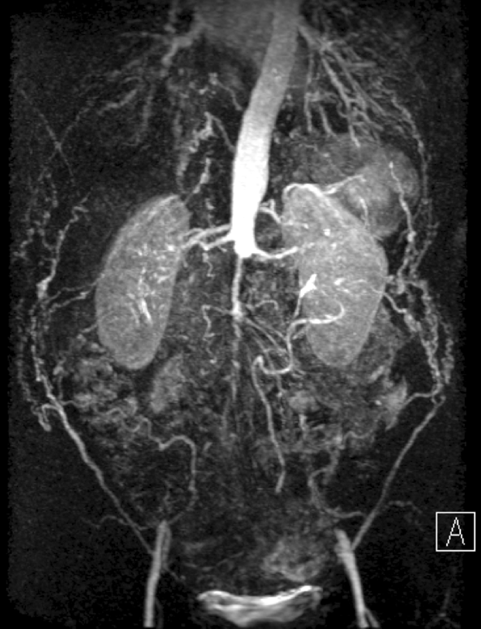 Abb. 1: Aortoiliakale Okklusion durch eine besondere Variante der PAVK, das Leriche-Syndrom. Mit der endovaskulären Behandlung gelang die Wiedereröffnung der Gefäße (davor). 