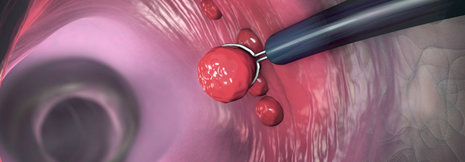 Diagnostik und Resektion von Polypen im unteren Gastrointestinaltrakt
