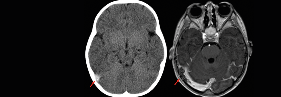 Anzeichen für eine Sinusvenenthrombose (Pfeil) sind kontinuierlich zunehmende Schmerzen und epileptische Anfälle.
