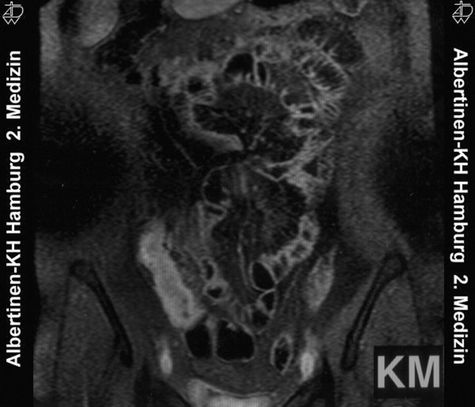 Ein Auslassversuch von Methotrexat endet nicht selten mit einem Rezidiv, so wie hier im terminalen Ileum.