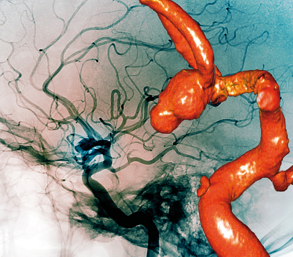 Bei einer 28-Jährigen stellt sich in der 
konventionellen 2D-Angiographie sowie in der CT-Angiographie (3D) ein zerebrales Aneurysma dar.