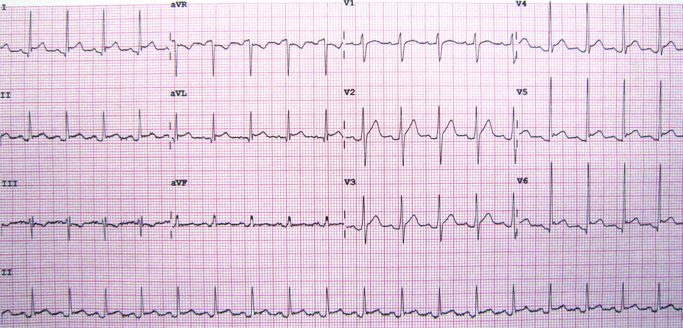 Perikarditis – Neue Leitlinie gibt Ihnen einen klaren Therapie-Plan an die Hand In diesem Perikarditis-EKG sieht man ST-Hebungen über der Vorderwand.
© wikimedia/James Heilmann.