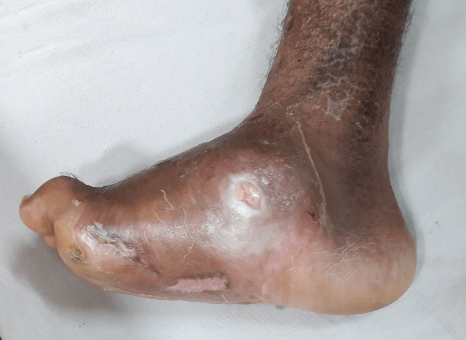 Dies ist ein Bild einer diabetischen Charcot-Fußdeformität mit einem ulzerierten Abszess.