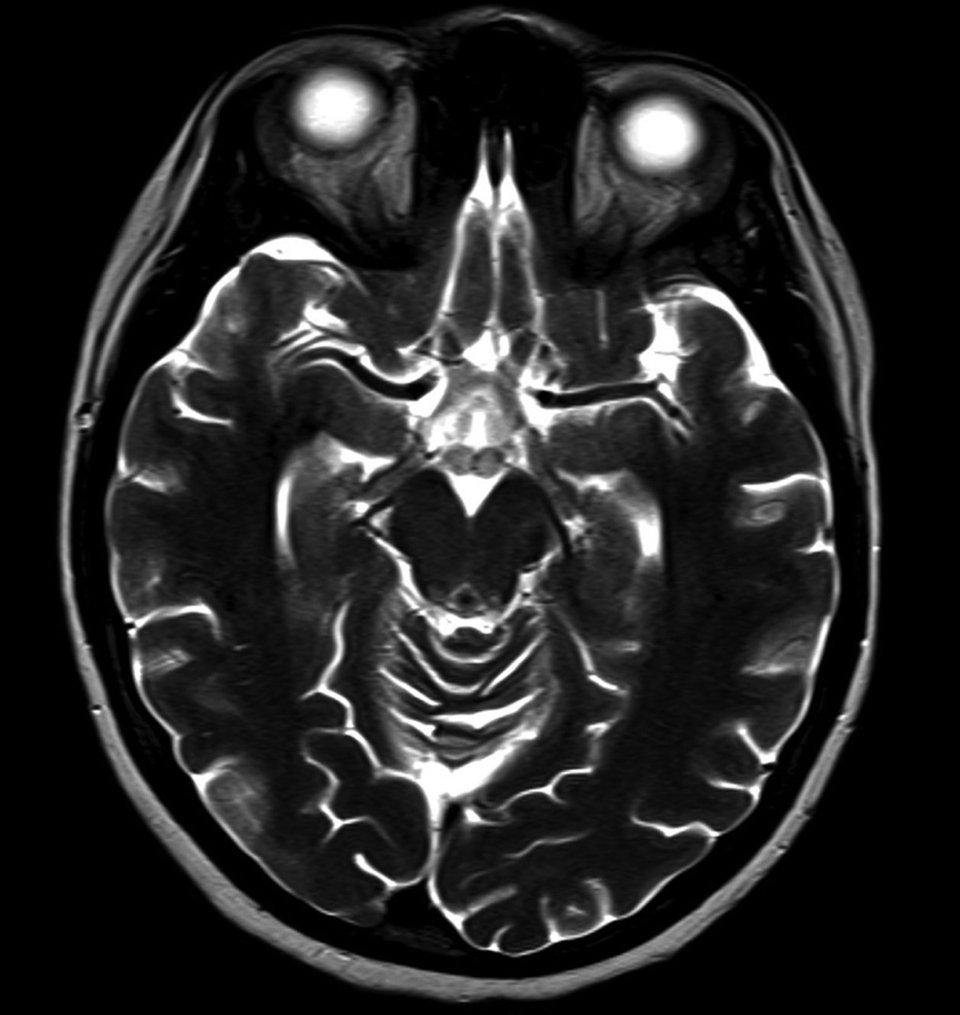 Eine Wenicke-Enzephalopathie betrifft vor allem Bereiche mit hohem Thiaminbedarf. Bei der Jugendlichen war es unter anderem die Corpora mamillaria.