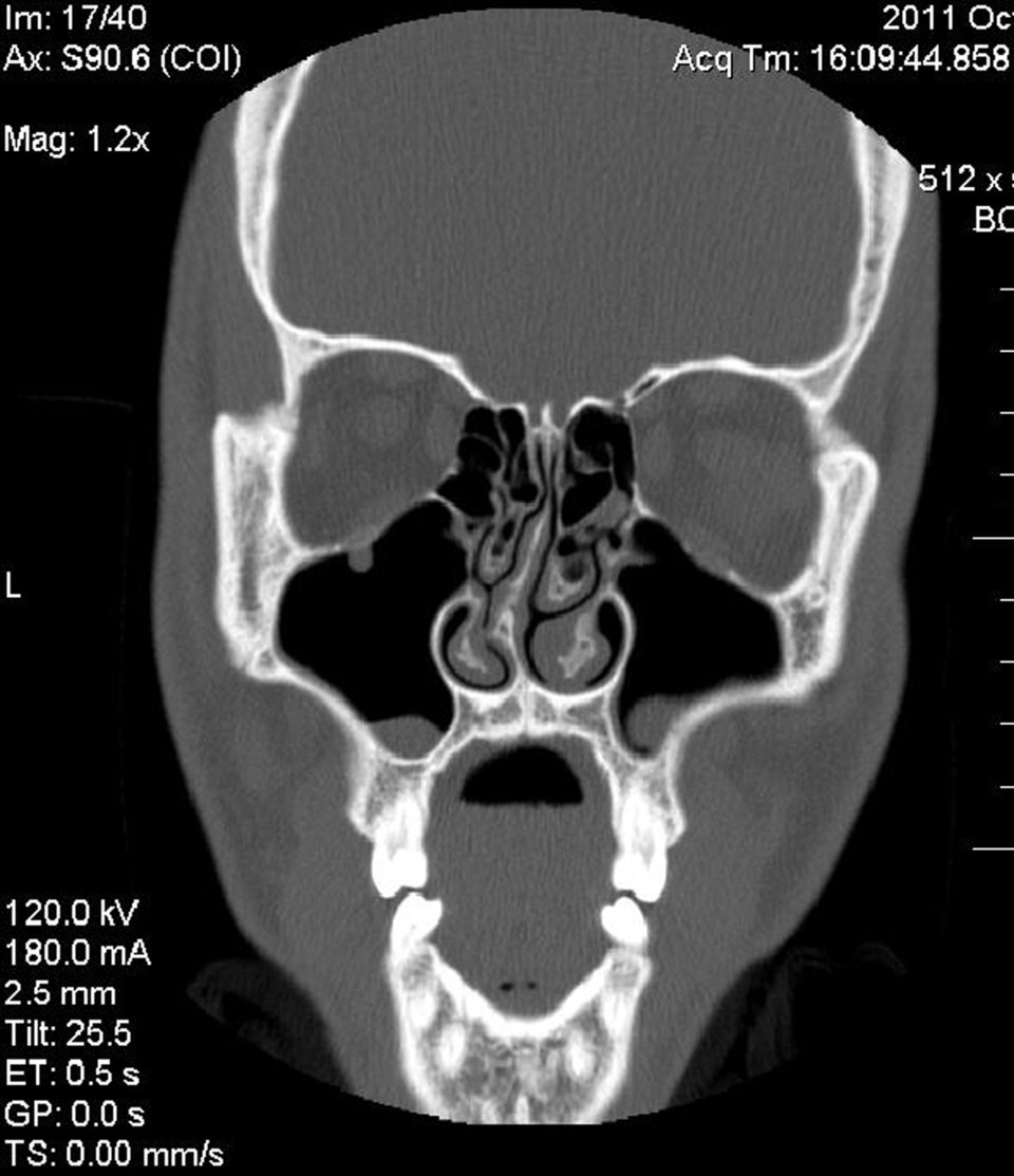 Oft ist die Nasenatmung durch eine Septumdeviation behindert.