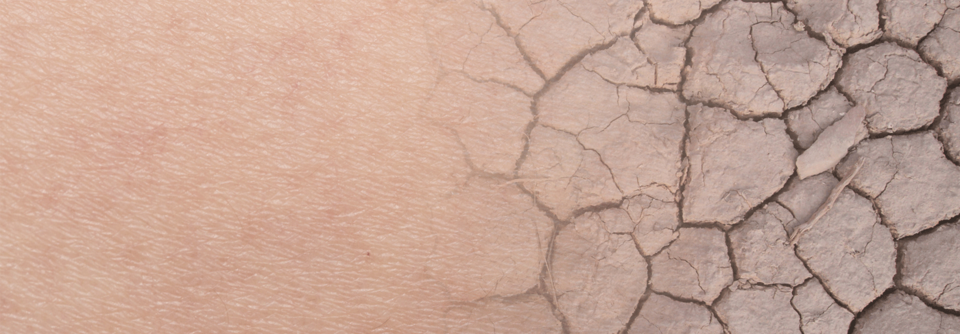 Für uns Menschen kann trockene Haut riskant sein.