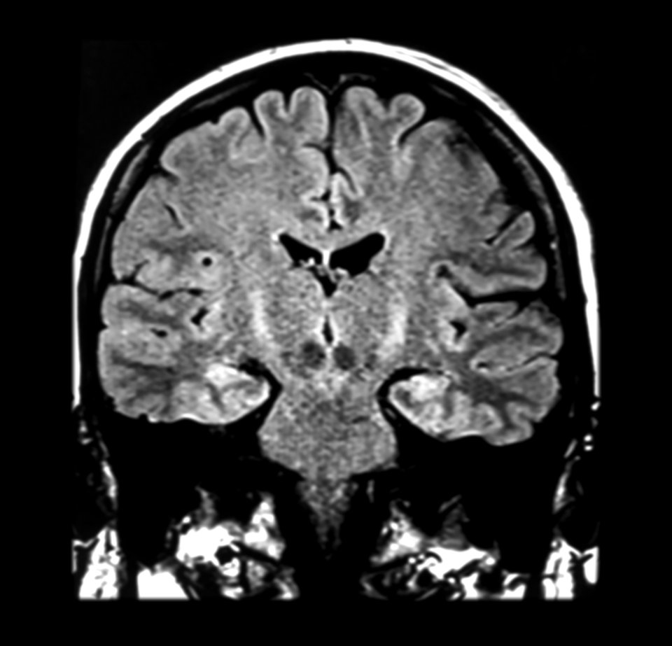 Bei einem ALS-Patienten ist in der FLAIR-Sequenz entlang des Kortiko­spinaltrakts eine pathologisch 
erhöhte Signalintensität erkennbar.
