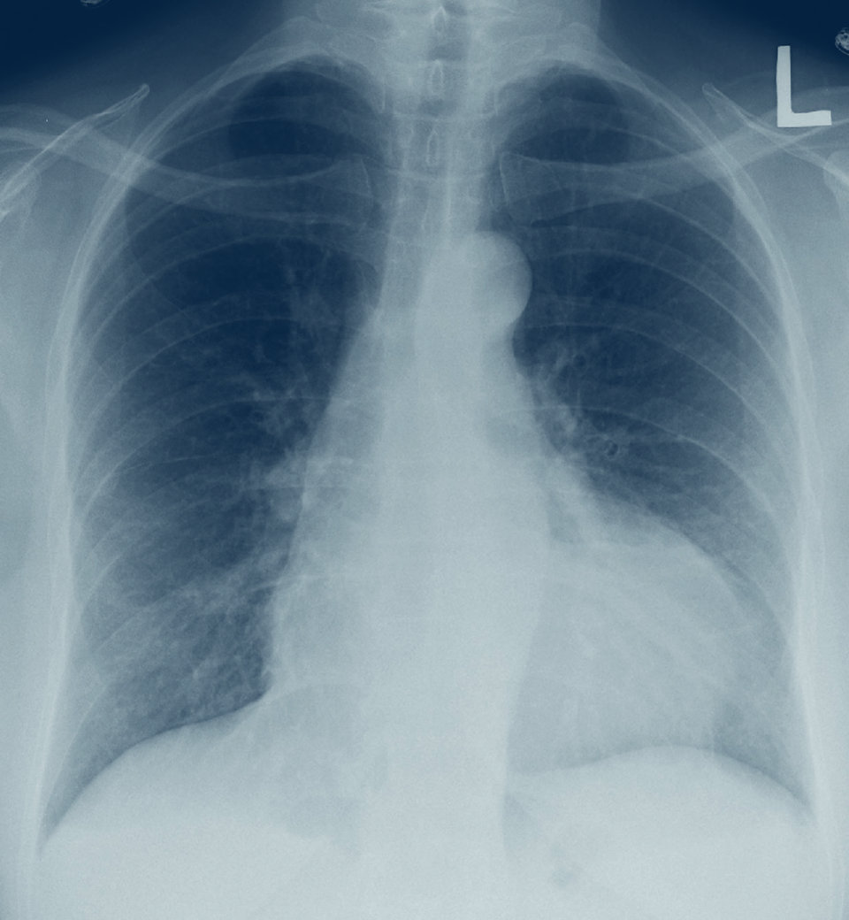 Ein großer Perikarderguss hat das Herz radiologisch stark vergrößert.
© wikimedia/James Heilmann.