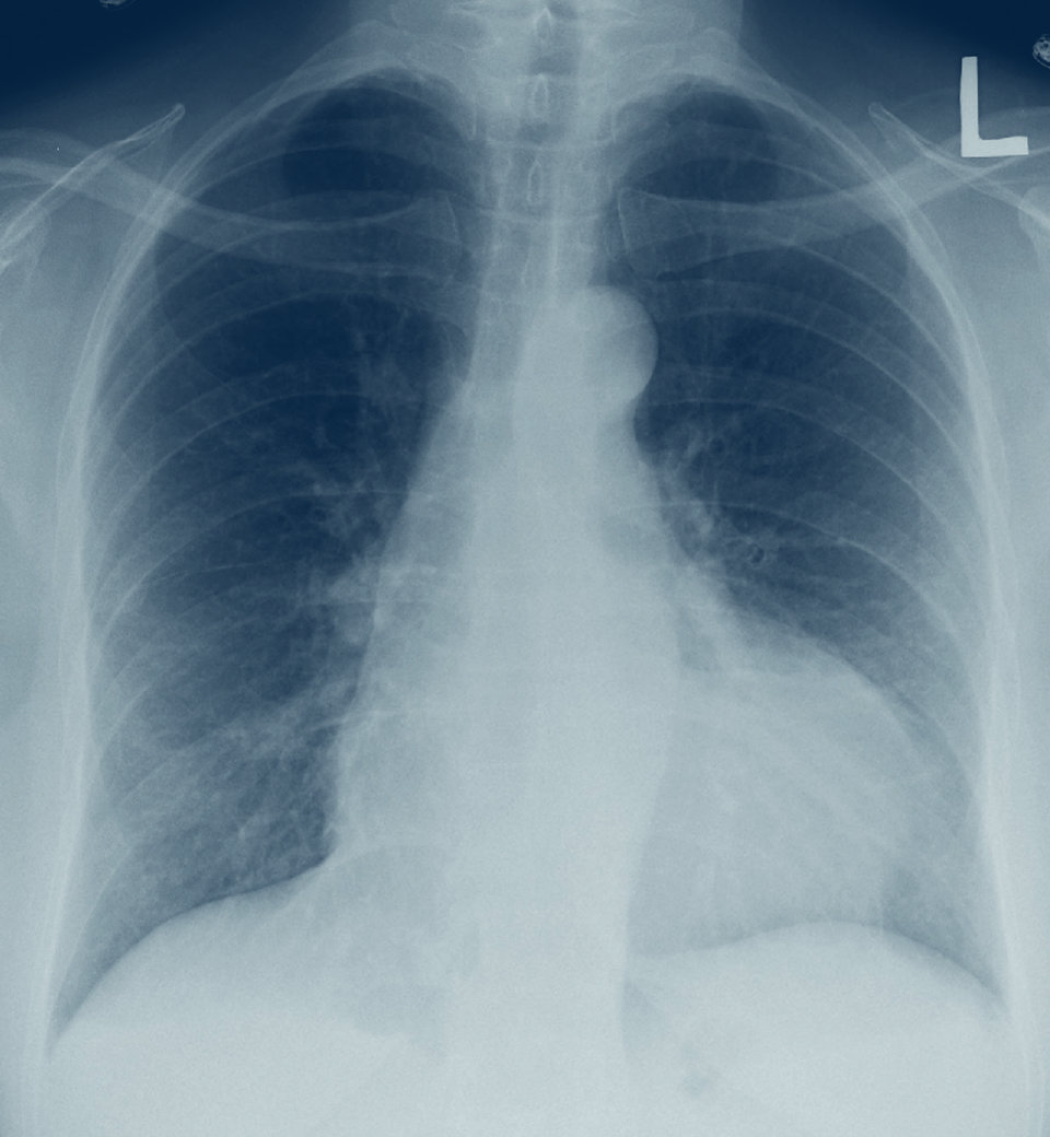 Perikarditis – Neue Leitlinie gibt Ihnen einen klaren Therapie-Plan an die Hand Ein großer Perikarderguss hat das Herz radiologisch stark vergrößert.
© wikimedia/James Heilmann.