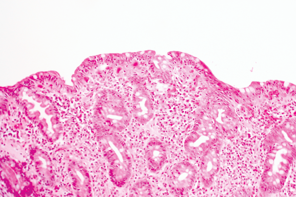 medikamenteninduzierte Enteritis