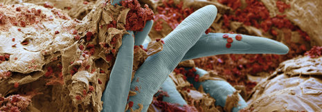 Demodex-Milben können Rosazea auslösen