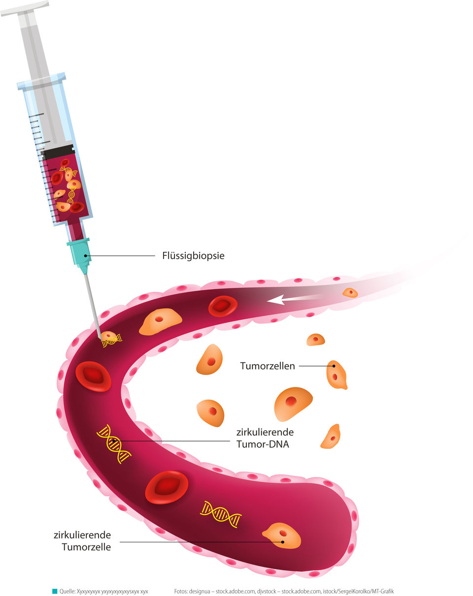 Darstellung einer Liquid Biopsy