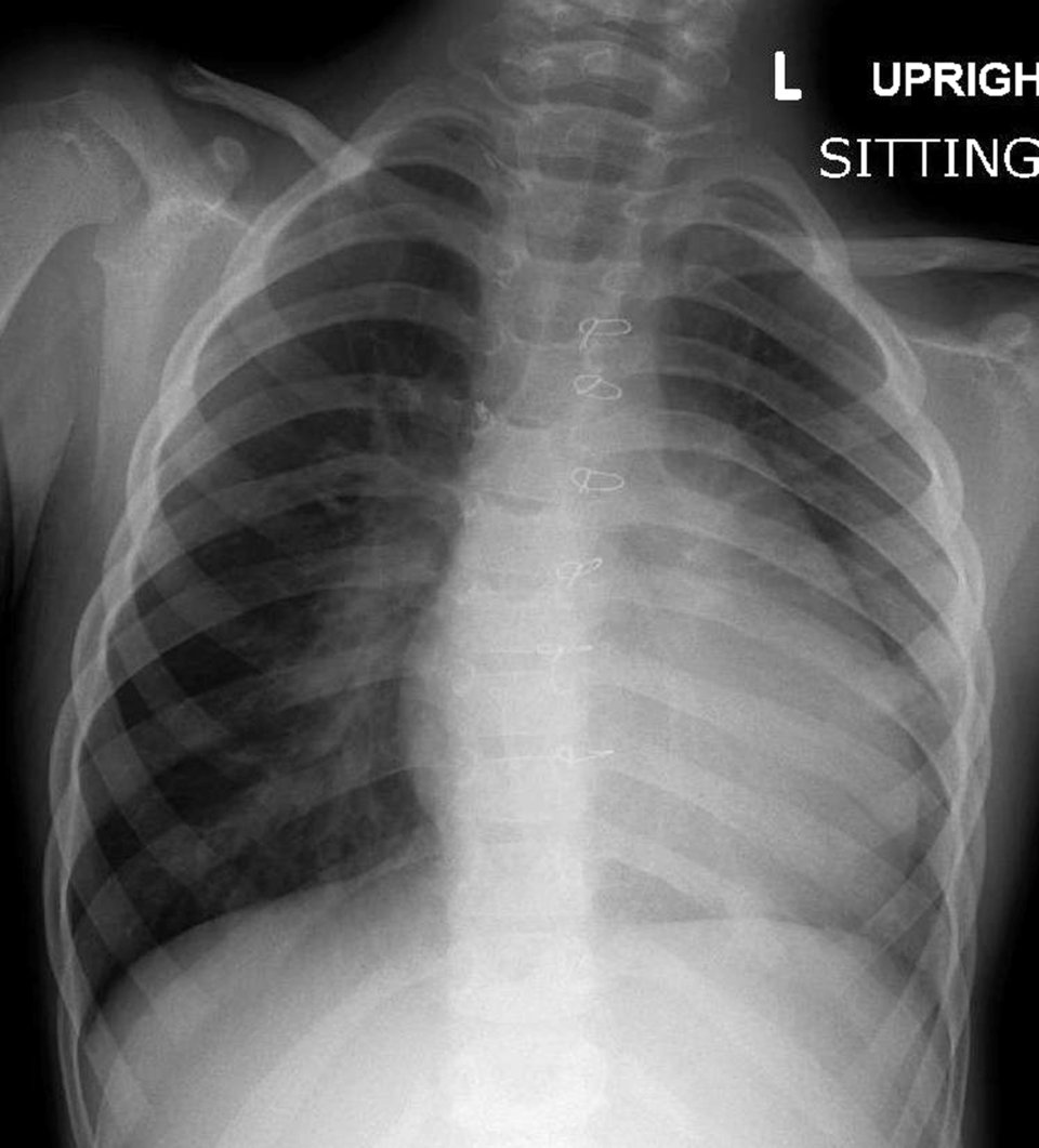 Ventrikelseptumdefekt
