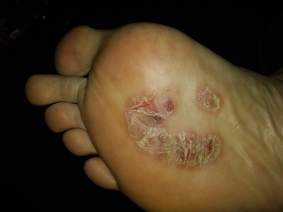 Mycosis fungoides am Fuß, die häufig mit einer Psoriasis verwechselt wird.