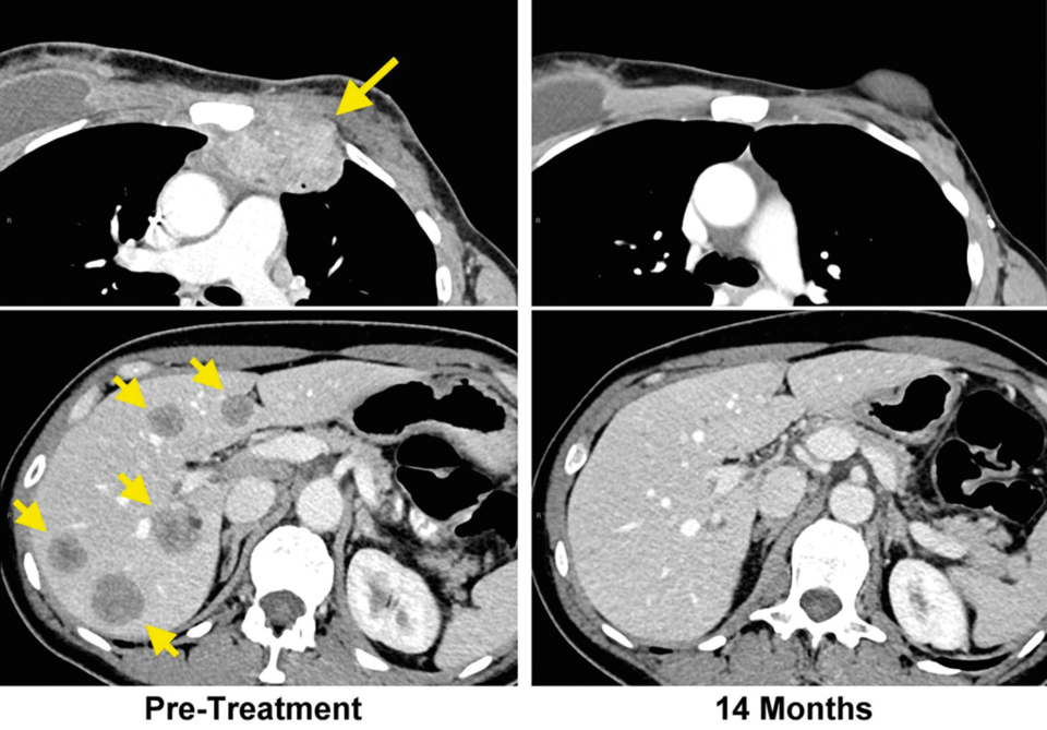 Im CT der Patientin mit chemotherapieresistentem, metastasiertem Brustkrebs sind die Filiae in Brustwand (links oben) und Leber (links unten) deutlich zu erkennen. 14 Monate nach der speziellen adoptiven Immuntherapie ist der CT-Befund unauffällig (rechts oben, rechts unten).
