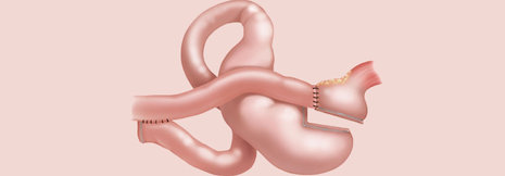 Magenbypass: NAFLD-Patienten profitieren von langfristiger Diabetesremission