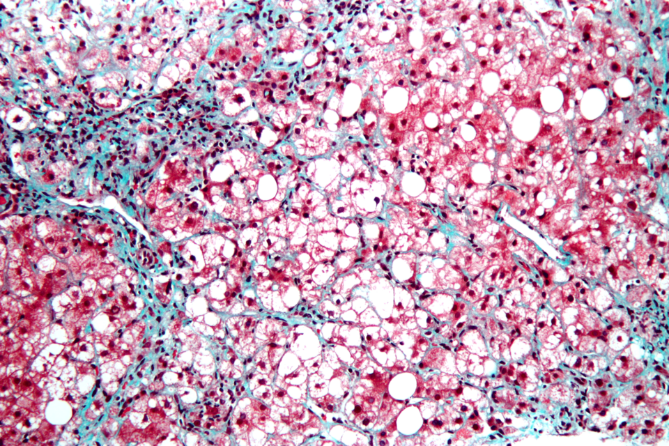 Hochvergrößerte mikroskopische Aufnahme einer Steatohepatitis