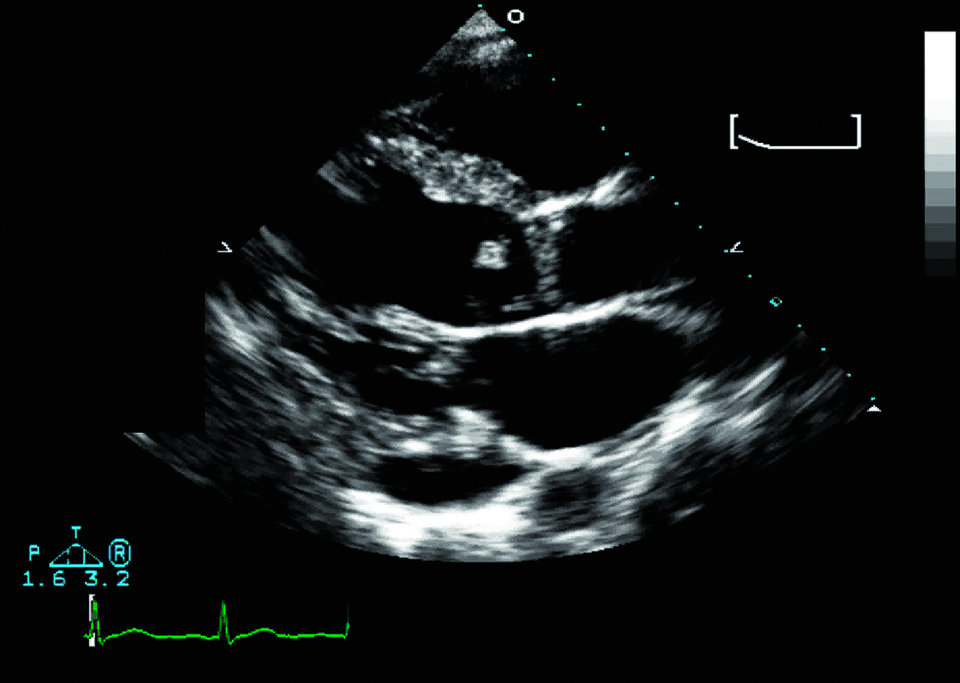 Komplikationen der Endokarditis – Mehrmals täglich auskultieren, bei schlechten Schallbedingungen CT anfordern Jassal D. et al.