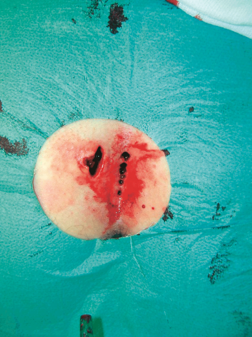 Bei diesem Patienten konnte der Sinus pilonidalis mittels „pit picking“ behandelt werden.
