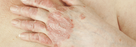 Psoriasispatienten haben öfter verkalkte Koronarien