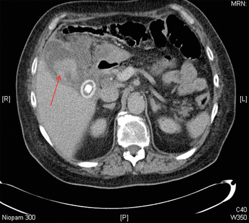 Es ist nicht die Leber, die blutet: Die Hämorrhage befindet sich in der geblähten Gallenblase und ist als heterogene Masse zu erkennen. Zusätzlich sind Wandverdickungen auf dem CT sichtbar (roter Pfeil).