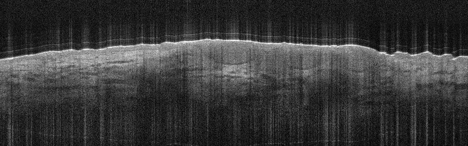 Das superfizielle BCC ist charakterisiert durch die oberflächlichen Tumornester, die wie Perlen an einer Kette aufgereiht von der Epidermis in die darunterliegende Dermis ragen.