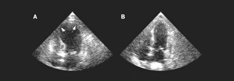 Schilddrüsenstörungen begünstigen Broken-Heart-Syndrom