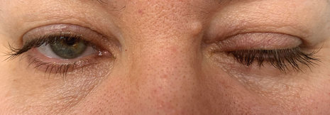 Myasthenia gravis symptomatisch und immunsuppressiv therapieren