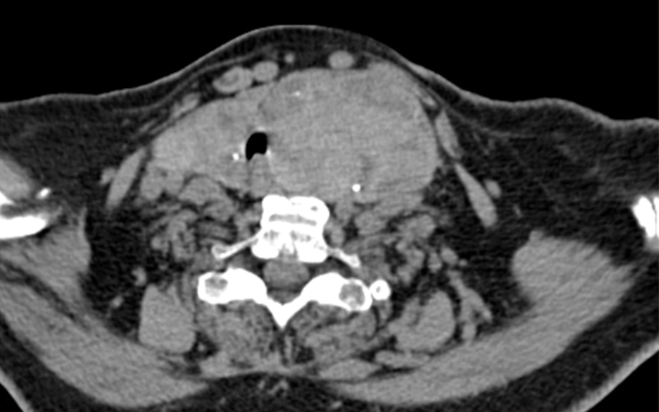 Dieses 300 ml große asymmetrische Organ hat bereits die Trachea verschoben.