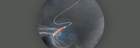 Stent kann bei extrakranieller Dissektion der Halsschlagader die Prognose bessern
