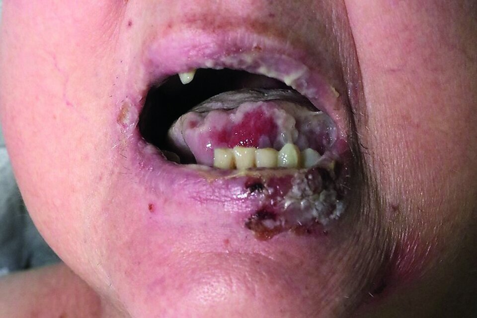 Abb. 3: Beim Pemphigus vulgaris sieht man oft nur Blasenreste und oberflächliche Erosionen. Impetiginisierungen sind häufig. Die Mundschleimhaut trifft es oft.
