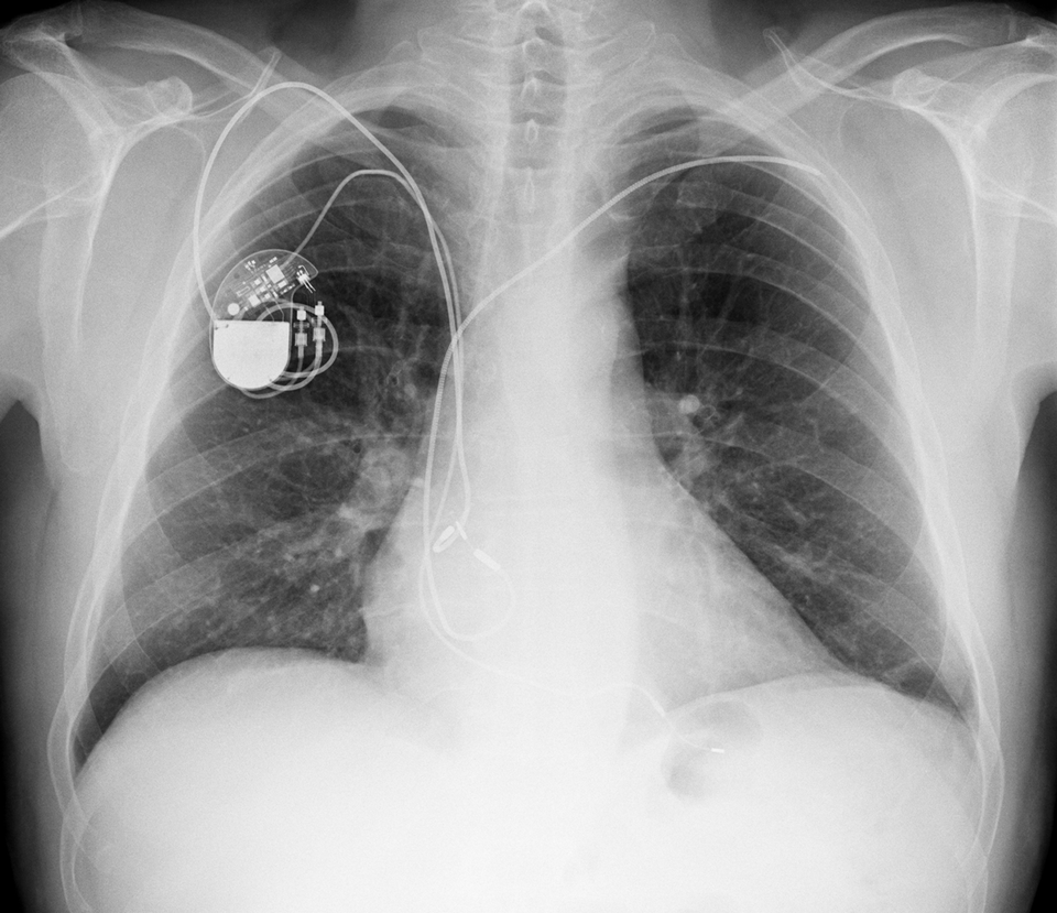 Bei diesem Patienten entschied man sich gegen eine Extraktion. Die inaktive Sonde läuft bis unter die linke Clavivula.