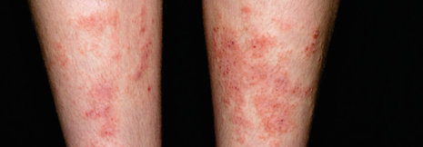 Dermatosen bei Sportlern: UV-Strahlung, Erreger und Allergene setzen der Haut zu