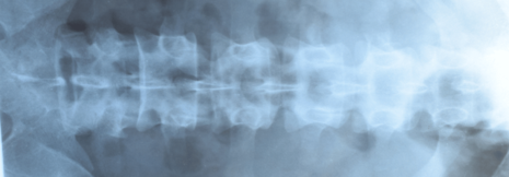 Spondyloarthritis: Nächtlicher Aufwachschmerz im Rücken