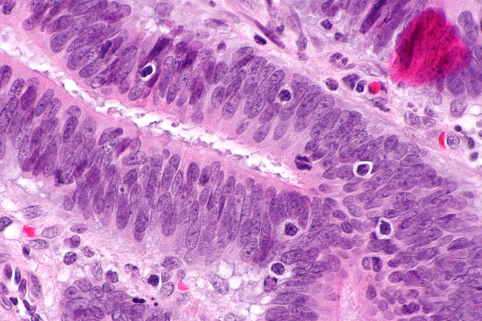 Mikrofoto von Dickdarmkrebs mit Lymphozyten im Tumor, wie es oft beim Lynch-Syndrom vorkommt.