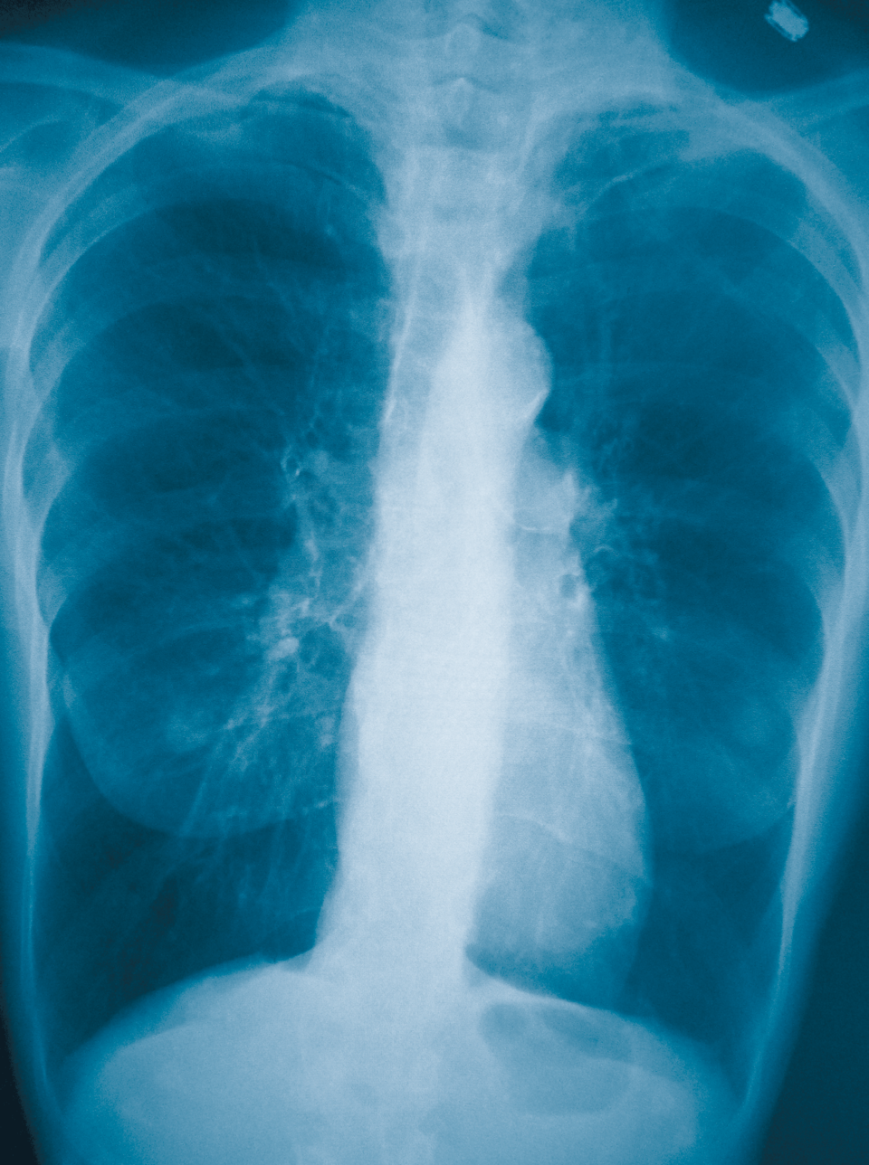 Die Therapie der COPD gestaltet sich immer
komplexer. ICS kommen nur noch für bestimmte Patienten infrage.