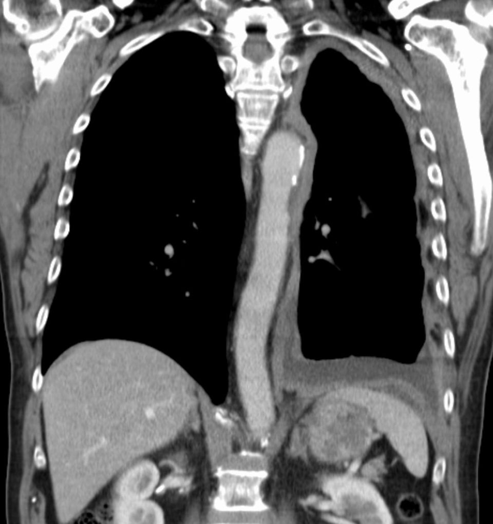 Mesotheliom der Pleura links in der Computertomographie: Mantelförmige Verdickung der Pleura mit Pleuraerguss.