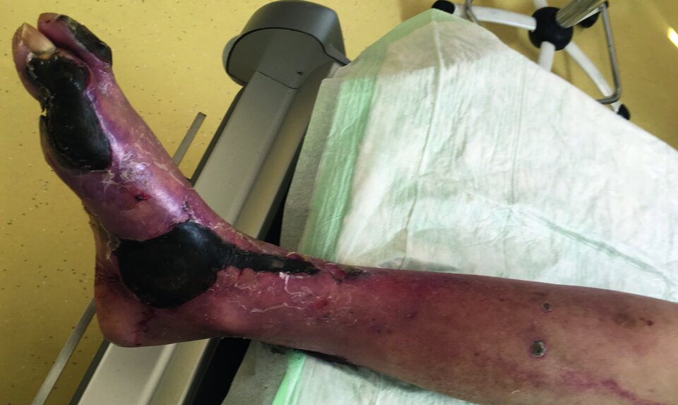 Abb. 1: Arterielles Ulkus mit großen nekrotischen Platten an Zehen und Fußrücken. Pathognomonisch sind fehlende Fußpulse, Abblassen des angehobenen Fußes und scharf begrenzte Wundränder.