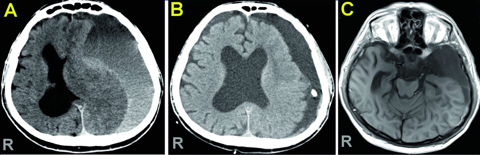 Abb.2: Subduralhämatom mit massiver Verdrängung des Gehirns nach rechts in der MRT (A). Die Trepanation führte zu einer deutlichen Entlastung der linken Gehirnhälfte (B). Als Ursache zeigte sich eine große Arachnoidalzyste im Bereich des rechten Temporalpols (C).